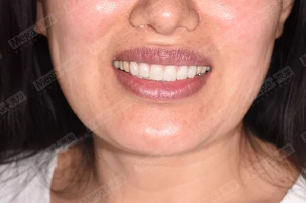 美加案例分享：牙齿矫正+牙齿美白，40岁的美丽人生从“齿”开始