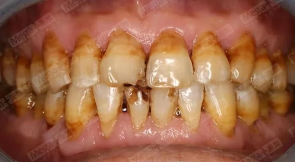 四环素牙术前口内照