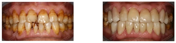 修复前后对比—口内照
