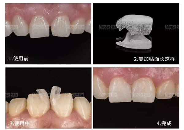 什么是牙齿贴片？