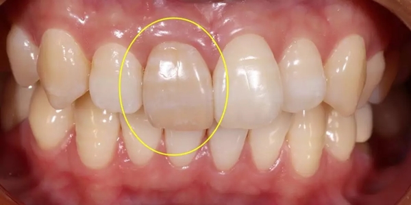 变色了的死髓牙能用牙齿贴面来美白吗？