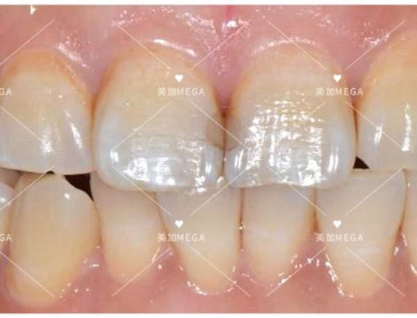门牙修复案例