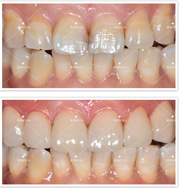 美加贴面修复轻度龋齿