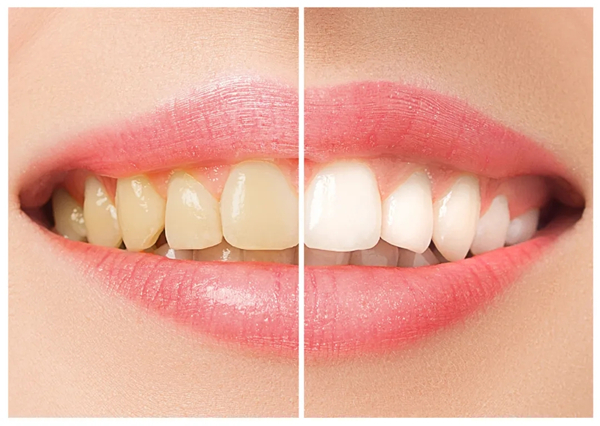 你的牙黄可能是这6大原因导致的哦！