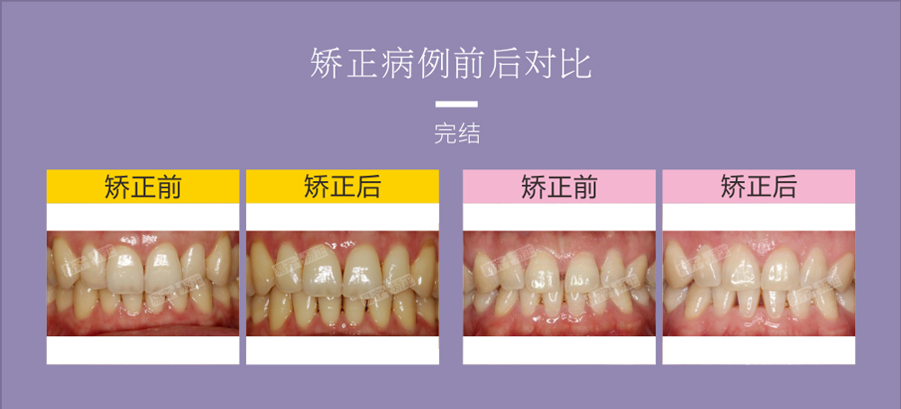 透明矫正完结案例1