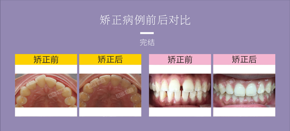 透明矫正完结案例4